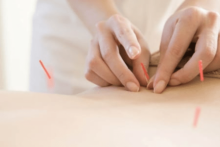 Acupunctuur naalden